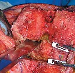 الخيارات العلاجية المتدرجة للتعامل مع تصلب الركبة