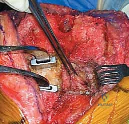 التحضير لجراحة المراجعة المعقدة في غرفة العمليات المجهزة