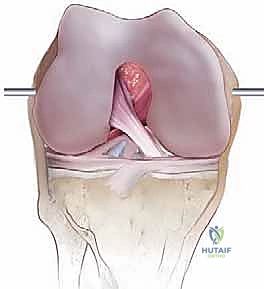 صورة توضيحية لـ جراحة مراجعة مفصل الركبة المتصلب علاج شامل لاستعادة الحركة في صنعاء مع الأستاذ الدكتور محمد هطيف