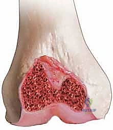 التخطيط الدقيق والخطوات المنهجية لجراحة مراجعة الركبة