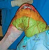 صورة توضيحية لـ جراحة مراجعة مفصل الركبة المتصلب علاج شامل لاستعادة الحركة في صنعاء مع الأستاذ الدكتور محمد هطيف