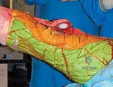 التأثير الميكانيكي والاختلالات التي تؤدي إلى تصلب الركبة بعد الاستبدال