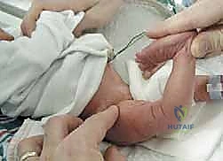 الميكانيكا الحيوية لمفصل الركبة المخلوع