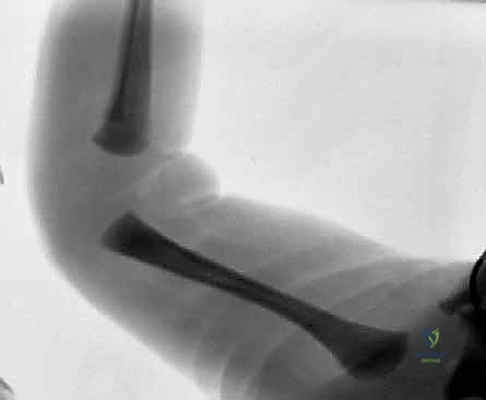 أسباب وعوامل خطر خلع الركبة الخلقي