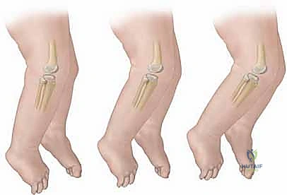 قصة نجاح: طفل يمارس حياته الطبيعية بعد علاج خلع الركبة
