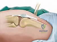 برنامج التأهيل والعلاج الطبيعي بعد الجراحة