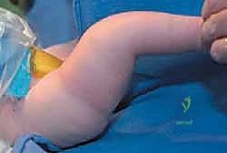 خلع الركبة الخلقي عند الأطفال: دليل شامل للعلاج والتعافي مع الأستاذ الدكتور محمد هطيف