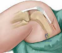 تشخيص وتقييم خلع الركبة الخلقي