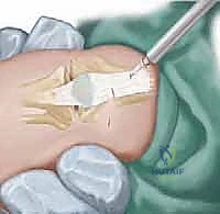 إغلاق الجرح ووضع الجبيرة الجبسية