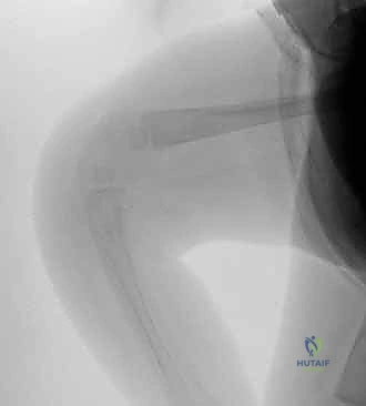 خطوات تطويل العضلة الرباعية V-Y