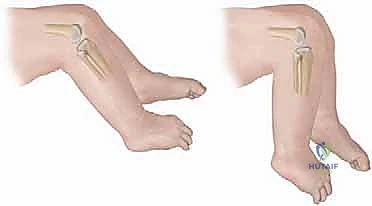 تقييم وعلاج التشوهات المصاحبة لخلع الركبة