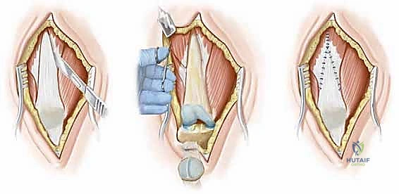 رد المفصل والتثبيت بالأسلاك المعدنية