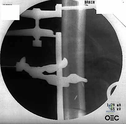 Mastering Intercalary Reconstruction: Allografts and Segmental Endoprostheses