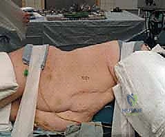 التشريح الدقيق للعمود الفقري الصدري وأهمية الوصول الأمامي