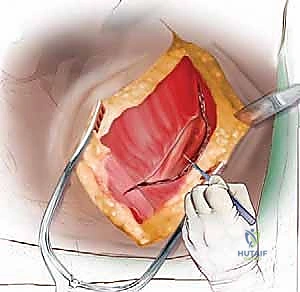 تشخيص دقيق لحالة كسر في الفقرات الصدرية قبل التدخل الجراحي