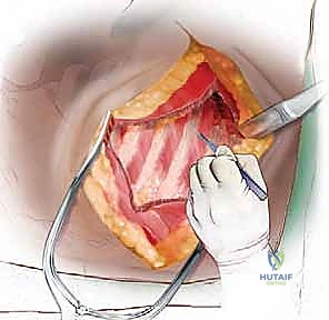 مرحلة الوصول الجراحي الدقيق للعمود الفقري عبر التجويف الصدري