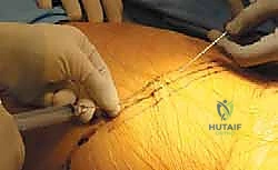 جلسات العلاج الطبيعي المخصصة لمرضى جراحات العمود الفقري الصدري