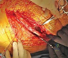 أشعة قبل وبعد العملية توضح تصحيح التشوه وتثبيت الكسر بنجاح