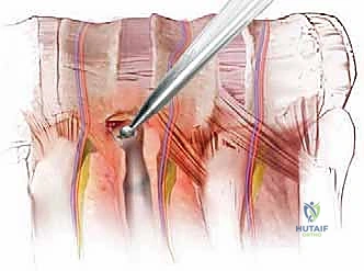 الأستاذ الدكتور محمد هطيف أثناء إجراء تدخل جراحي دقيق في العمود الفقري