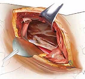 متابعة المريض في المستشفى وتشجيعه على الحركة المبكرة