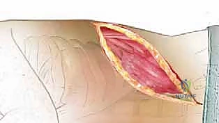 المدخل الأمامي للعمود الفقري الصدري: دليل شامل للمرضى مع الأستاذ الدكتور محمد هطيف في صنعاء