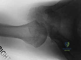 صورة توضيحية لـ إصلاح عدم استقرار الكتف الخلفي بالمنظار: دليل شامل للمرضى مع الأستاذ الدكتور محمد هطيف بصنعاء