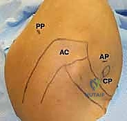 صورة توضيحية لـ إصلاح عدم استقرار الكتف الخلفي بالمنظار: دليل شامل للمرضى مع الأستاذ الدكتور محمد هطيف بصنعاء