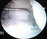 صورة توضيحية لـ إصلاح عدم استقرار الكتف الخلفي بالمنظار: دليل شامل للمرضى مع الأستاذ الدكتور محمد هطيف بصنعاء