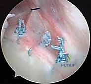 Illustration of treatment of posterior shoulder - Dr. Mohammed Hutaif