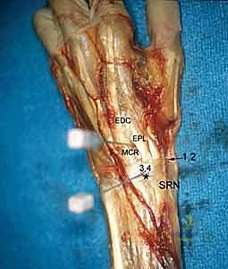 Wrist Arthroscopy: A Masterclass in Dorsal, Midcarpal, and Volar Portal Techniques
