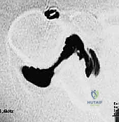 تمزق أربطة الكتف الأمامية