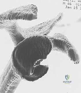 صورة توضيحية لـ عدم استقرار الكتف الأمامي: دليل شامل لإصلاح بانكارت وتثبيت المحفظة السفلية مع الأستاذ الدكتور محمد هطيف