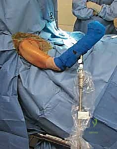 جلسة علاج طبيعي لتقوية عضلات الكتف