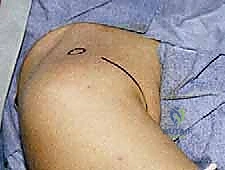 تشريح مفصل الكتف والأربطة الداعمة