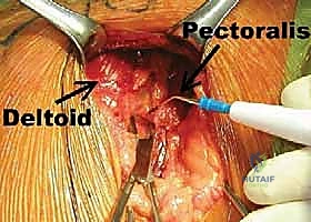صورة توضيحية لـ عدم استقرار الكتف الأمامي: دليل شامل لإصلاح بانكارت وتثبيت المحفظة السفلية مع الأستاذ الدكتور محمد هطيف