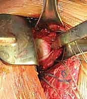 إدخال المنظار وتقييم المفصل من الداخل