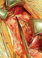 تصوير الرنين المغناطيسي لمفصل الكتف