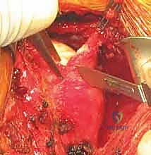 تمرير الخيوط وإصلاح آفة بانكارت