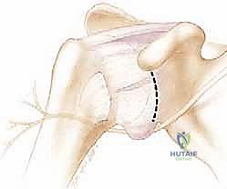 شد وطي المحفظة السفلية المترهلة