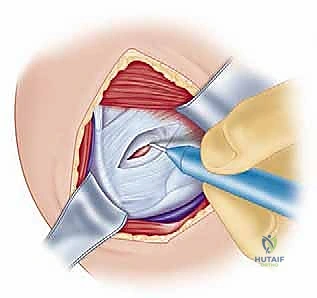 الأستاذ الدكتور محمد هطيف في غرفة العمليات