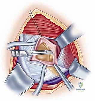 استخدام أحدث التقنيات الجراحية في اليمن
