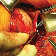 صورة توضيحية لـ عدم استقرار الكتف الأمامي: دليل شامل لإصلاح بانكارت وتثبيت المحفظة السفلية مع الأستاذ الدكتور محمد هطيف