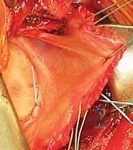 صورة توضيحية لـ عدم استقرار الكتف الأمامي: دليل شامل لإصلاح بانكارت وتثبيت المحفظة السفلية مع الأستاذ الدكتور محمد هطيف