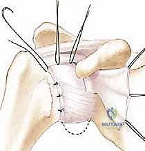 صورة توضيحية لـ عدم استقرار الكتف الأمامي: دليل شامل لإصلاح بانكارت وتثبيت المحفظة السفلية مع الأستاذ الدكتور محمد هطيف