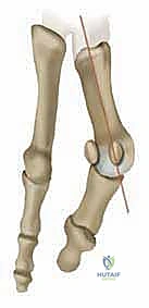 تفاصيل القطع العظمي المزدوج