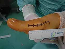 دقة التخطيط قبل القطع العظمي