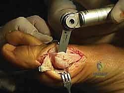 صورة طبية: جراحة ورم إبهام القدم الأروح المتقدم: تقنية شفرون ثنائية المستوى مع الأستاذ الدكتور محمد هطيف