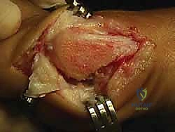 صورة طبية: جراحة ورم إبهام القدم الأروح المتقدم: تقنية شفرون ثنائية المستوى مع الأستاذ الدكتور محمد هطيف