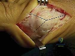 صورة طبية: جراحة ورم إبهام القدم الأروح المتقدم: تقنية شفرون ثنائية المستوى مع الأستاذ الدكتور محمد هطيف