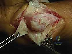 صورة طبية: جراحة ورم إبهام القدم الأروح المتقدم: تقنية شفرون ثنائية المستوى مع الأستاذ الدكتور محمد هطيف